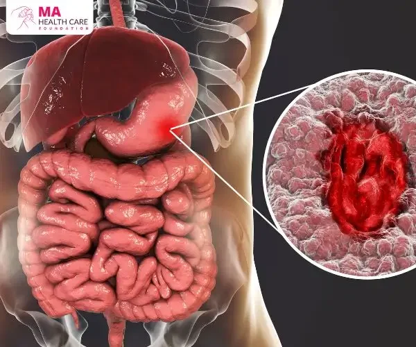 Nursing Care Plan for Gastric Cancer Nursing Care Plan for Gastric Cancer